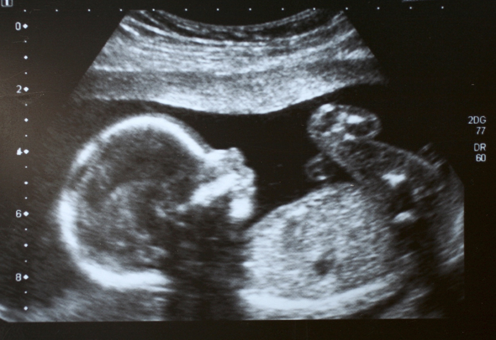 Loma Linda OB/GYN develops scan determining whether unborn babies are Adventist